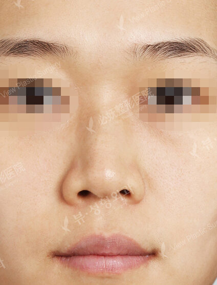 Hump Nose(3 Months) — Before