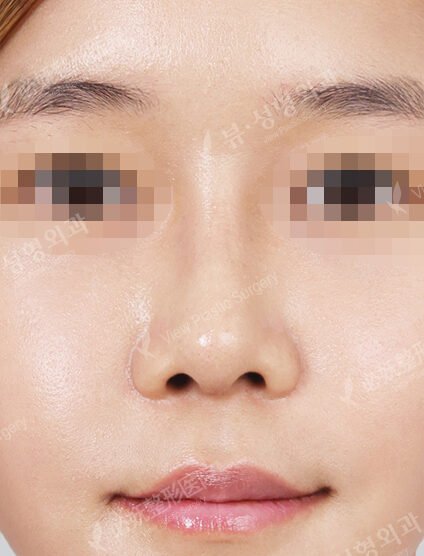 Hump Nose(3 Months) — After