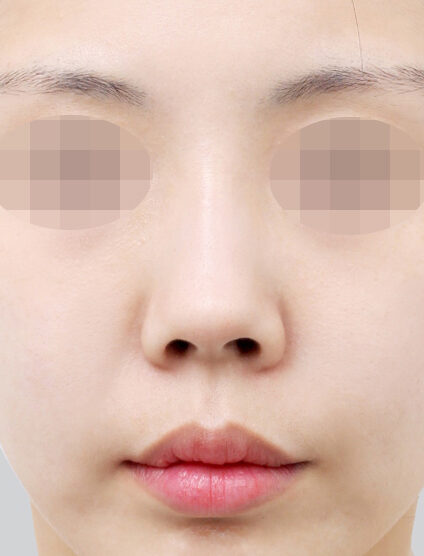 Rhinoplasty (9 Months) — Before
