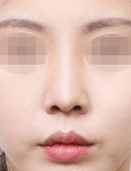 Rhinoplasty (9 Months) — After
