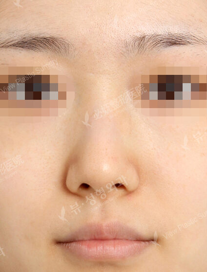 Hump Nose(1 Months ) — Before
