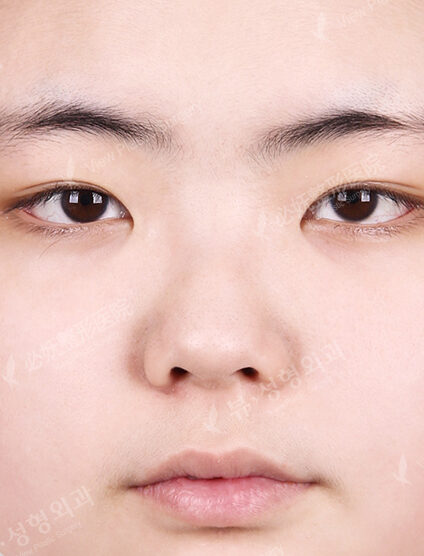 Rhinoplasty (7 Months) — Before