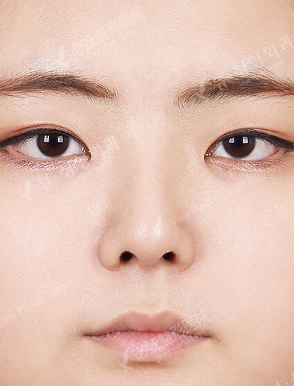 Rhinoplasty (7 Months) — After