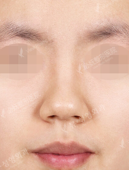 Rhinoplasty (6 Months) — Before