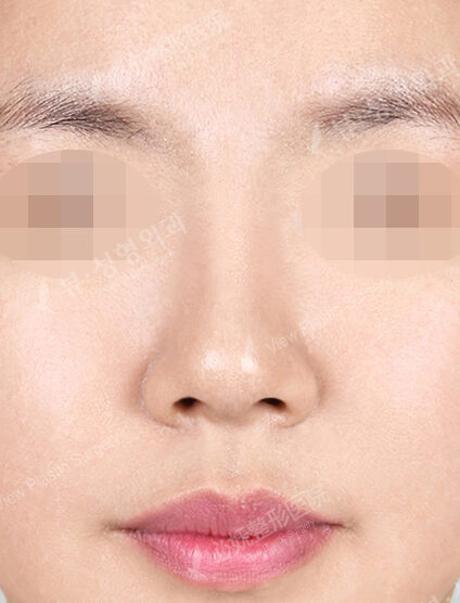 Rhinoplasty (6 Months) — After
