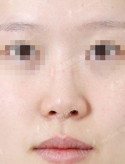 Low Nose (6 Months ) — Before