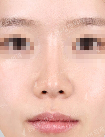 Low Nose (6 Months ) — After