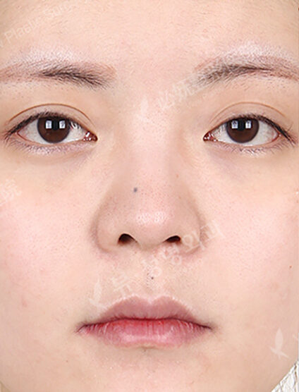 Revisional Rhinoplasty (4 Months) — Before