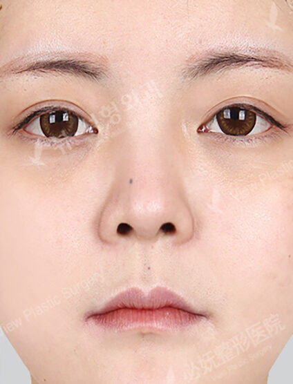 Revisional Rhinoplasty (4 Months) — After