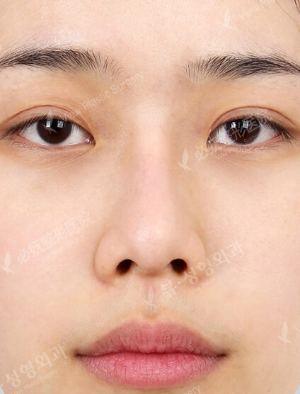 Rhinoplasty (9 Months) — Before