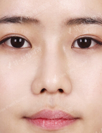 Rhinoplasty (9 Months) — After