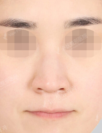 Rhinoplasty (11 Months) — Before