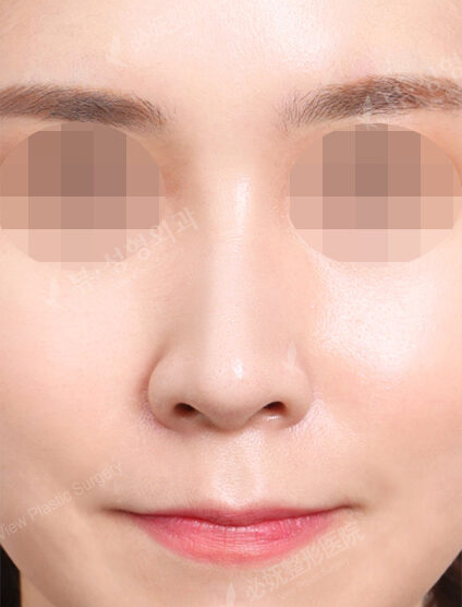 Rhinoplasty (11 Months) — After