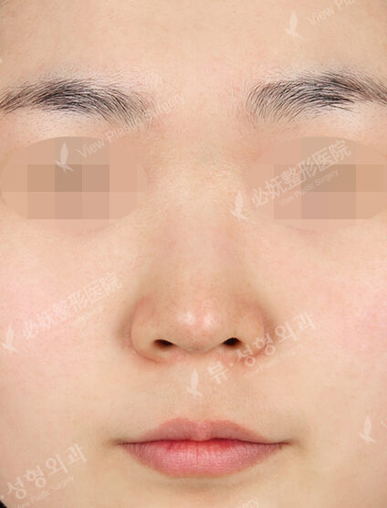Rhinoplasty (3 Months) — Before