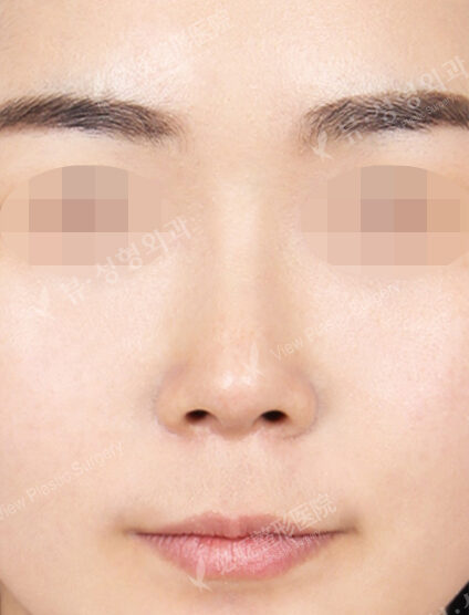 Rhinoplasty (3 Months) — After