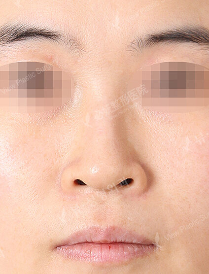 Hump Nose +Low Nose (3 Months) — Before
