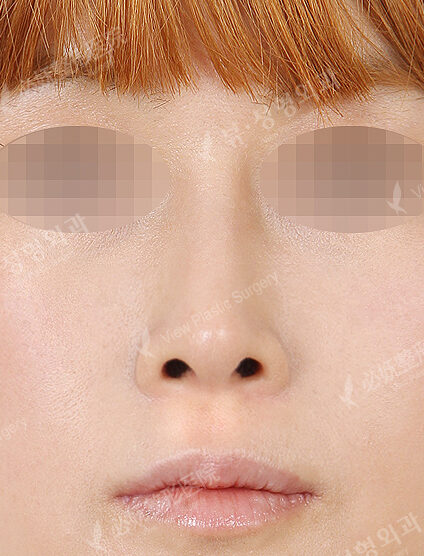 Hump Nose +Low Nose (3 Months) — After