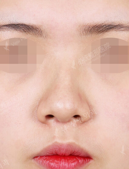 Hump Nose(3 Months) — Before