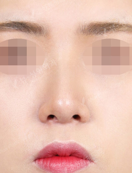 Hump Nose(3 Months) — After
