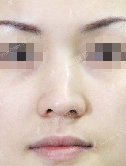 Hump Nose(3 Months ) — Before