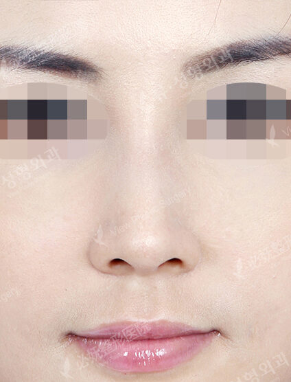 Hump Nose(3 Months ) — After