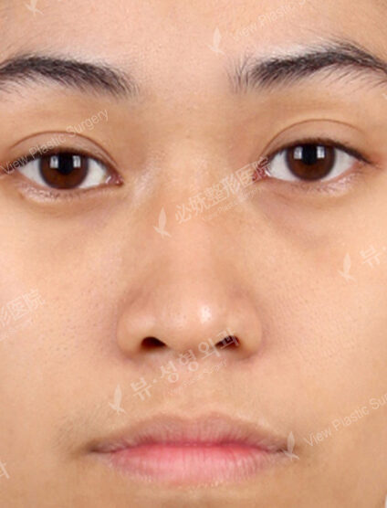Low Nose (2 Months ) — Before