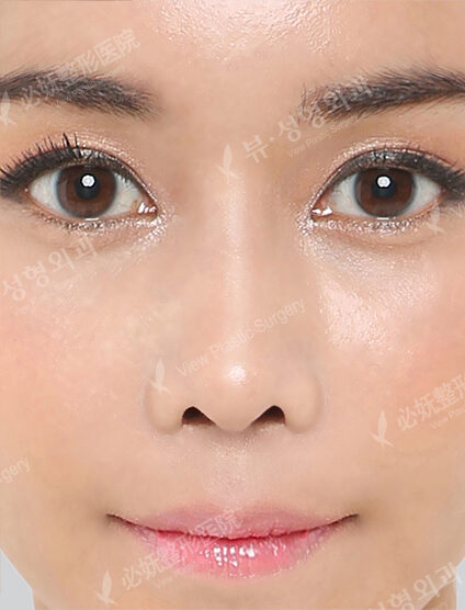 Low Nose (2 Months ) — After