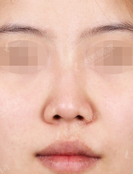 Rhinoplasty (7 Months) — Before