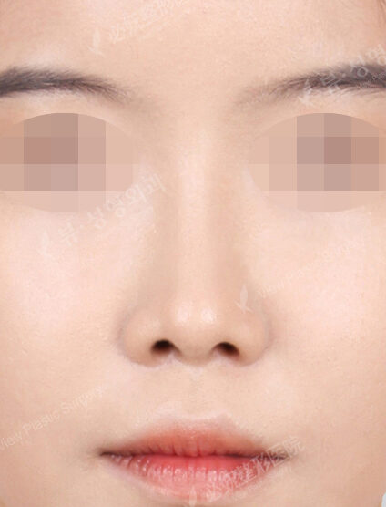Rhinoplasty (7 Months) — After