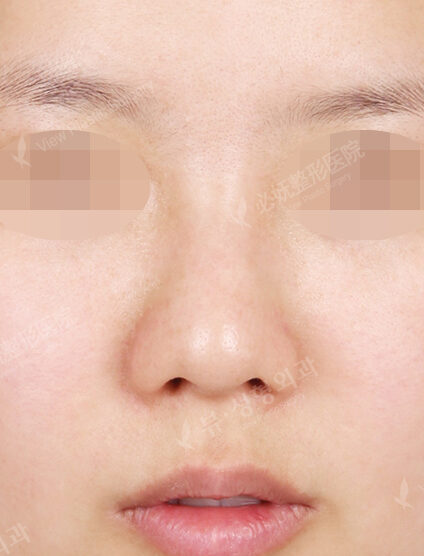 Hump Nose(16 Months) — Before