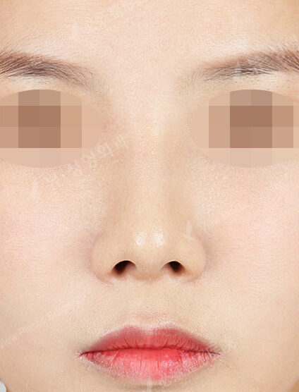 Hump Nose(16 Months) — After