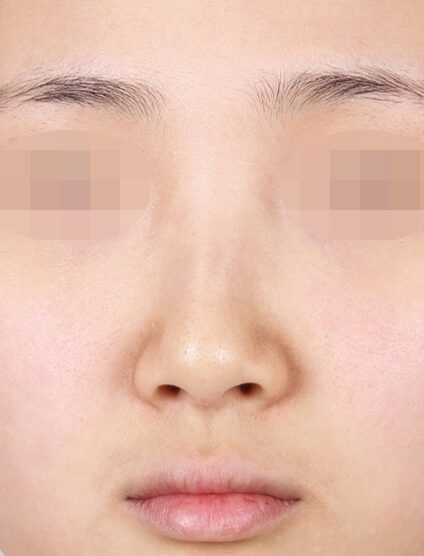 Hump Nose(3 Months) — Before