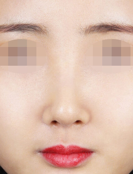 Hump Nose(3 Months) — After