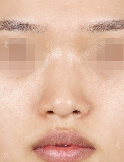 Rhinoplasty (3 Months) — Before