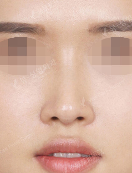 Rhinoplasty (3 Months) — After