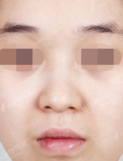 Hump Nose(11 Months) — Before