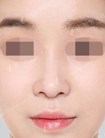 Hump Nose(11 Months) — After