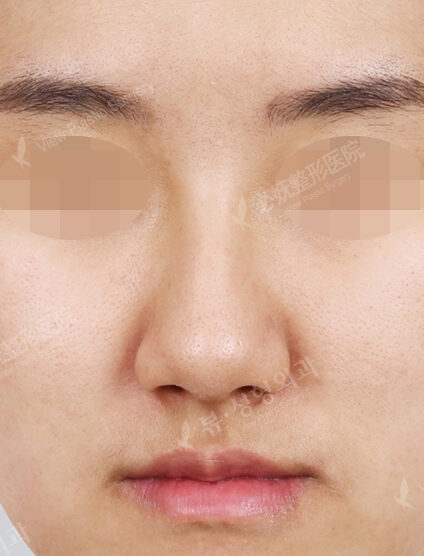 Hump Nose(9 Months) — Before