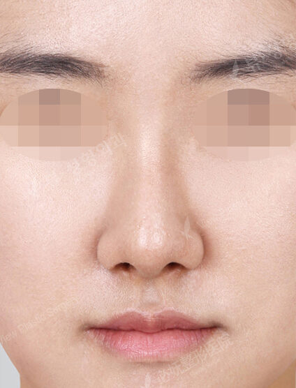 Hump Nose(9 Months) — After