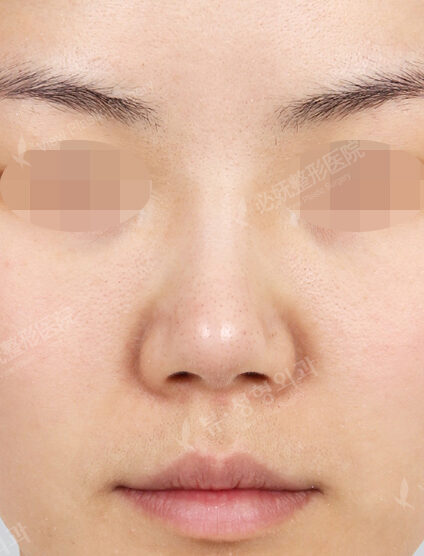 Revisional Rhinoplasty (8 Months) — Before