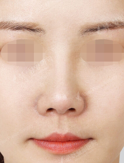 Revisional Rhinoplasty (8 Months) — After