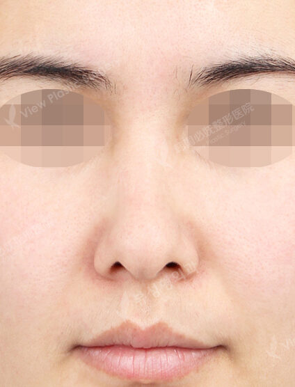Hump Nose(4 Months) — Before