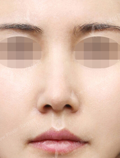 Hump Nose(4 Months) — After