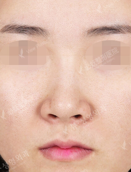 Rhinoplasty+Weir Reduction (3 Months) — Before