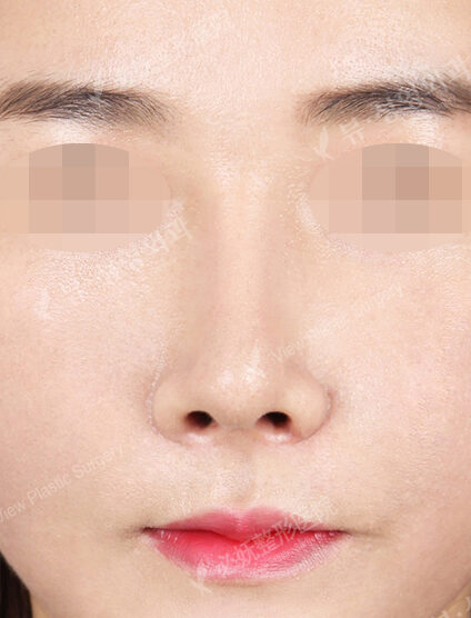 Rhinoplasty+Weir Reduction (3 Months) — After