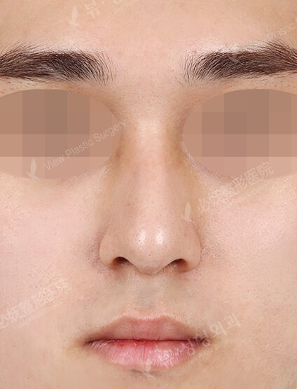 T.O.P Surgery+Hump Nose (4 Months) — Before
