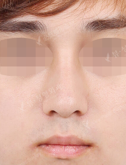 T.O.P Surgery+Hump Nose (4 Months) — After