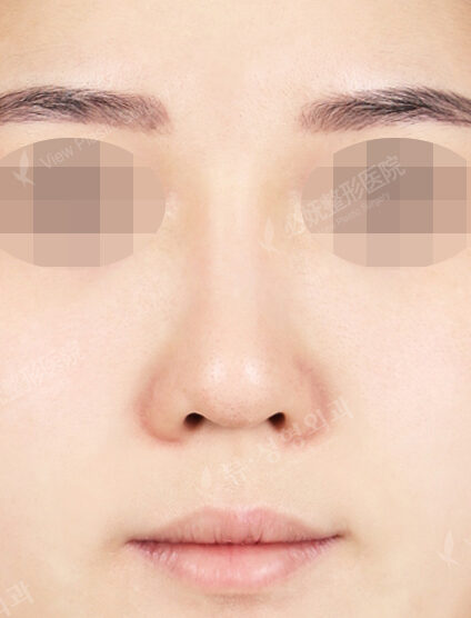 Revisional Rhinoplasty (5 Months) — Before