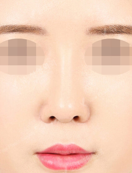 Revisional Rhinoplasty (5 Months) — After