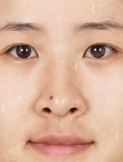 Hump Nose +Weir Reduction (6 Months) — Before